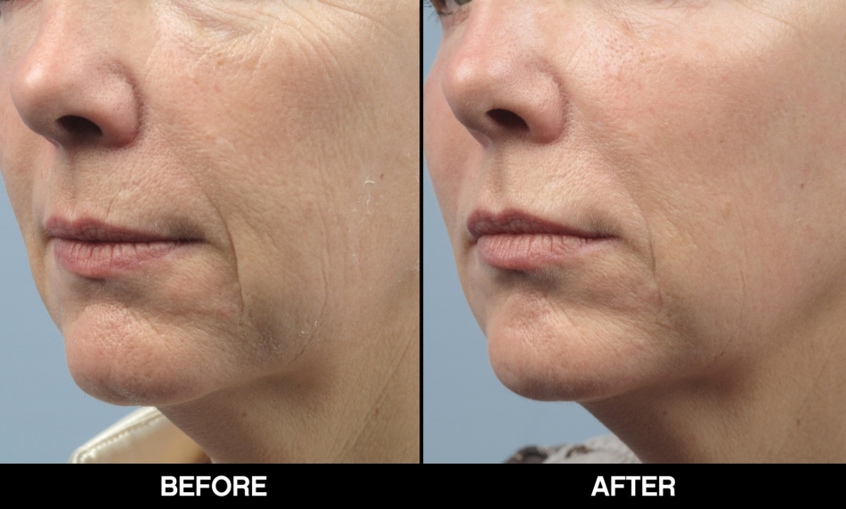 Mesotherapy - before and after