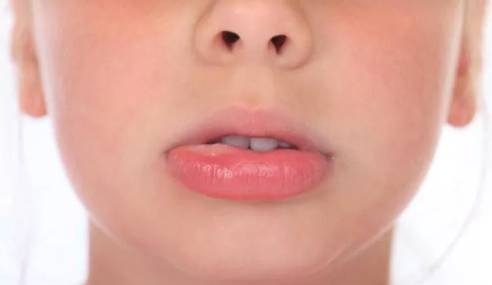 Swollen lower lip in a child