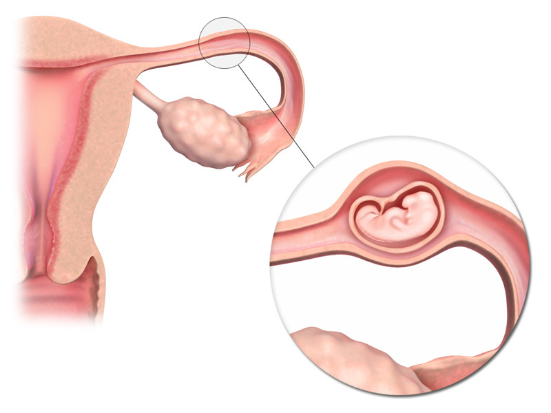 Pain syndrome occurs in the case of an ectopic pregnancy.