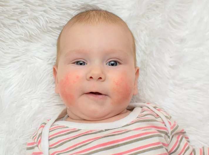 Die Kindermischung ist nicht für das Neugeborene geeignet: Hautausschlag, Allergien