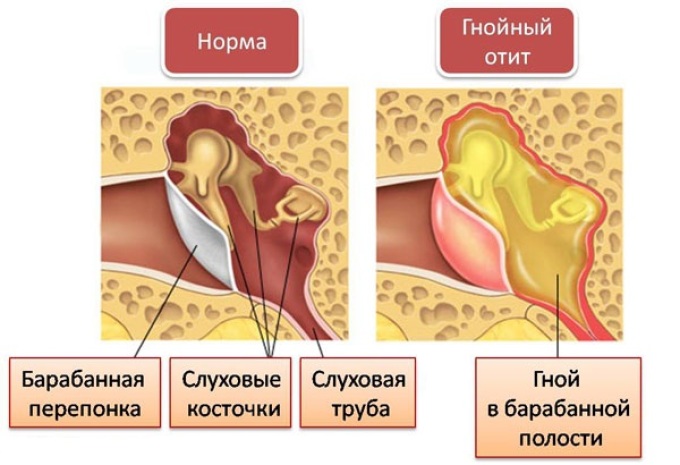 Purulent otitis media