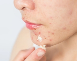 Acne on the face: which organs are responsible for. Rashes on the face in zones: What health problems are talking about?