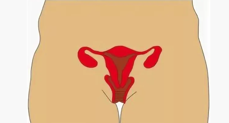 Prolaps uterus pada derajat pertama