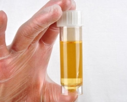 Transparent, colorless urine in a child, during pregnancy, pyelonephritis: causes. Why is the urine transparent, like water?