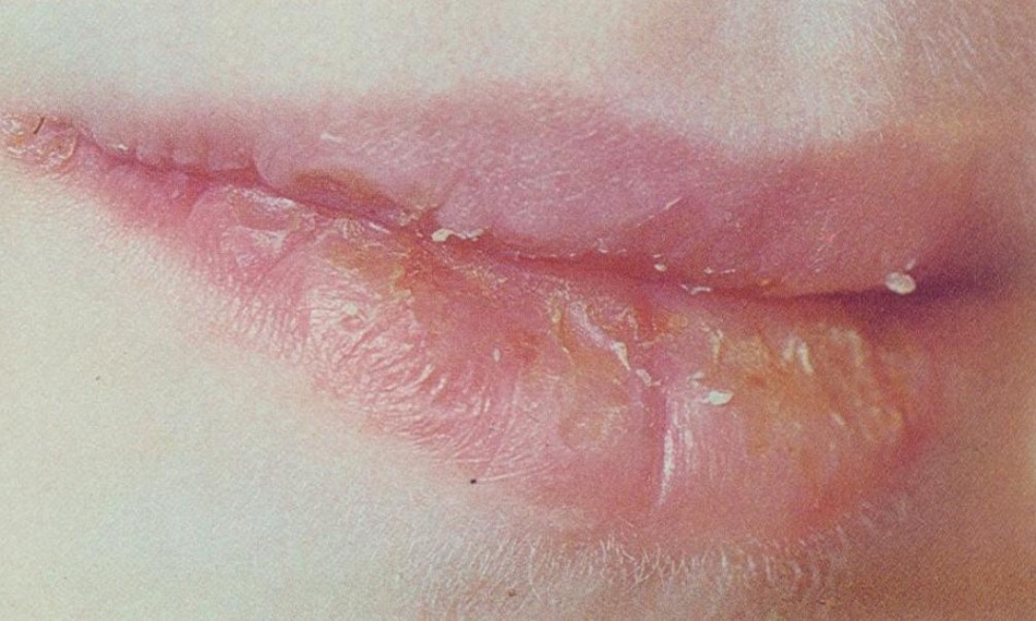 Хейлит губ