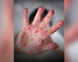 A rash on the palms and feet of a child: causes, methods of treatment. How to distinguish the rash on the palms and feet of a child with chickenpox, enterovirus, coksaki, measles?