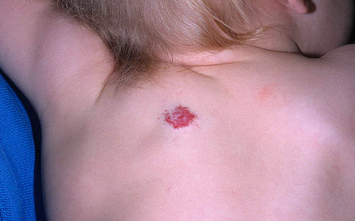 L'hémangiome au dos ne constitue pas une menace pour la santé de l'enfant