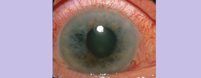 Glaucoma eye