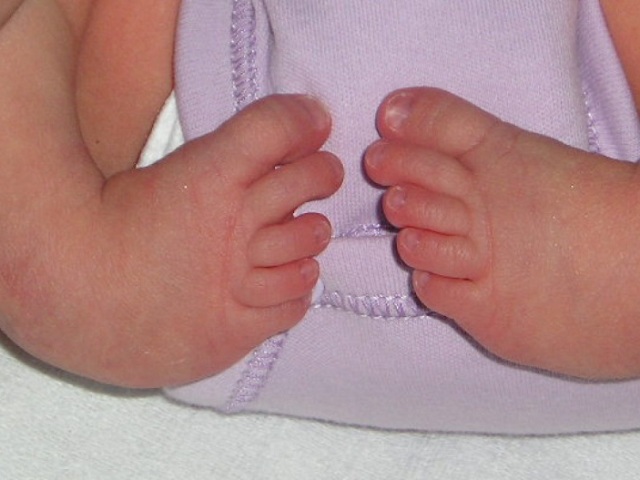 Kleidung bei Kindern: Zeichen, Ursachen, Behandlung. So reparieren Sie Clubfoot in einem Kind: Methoden