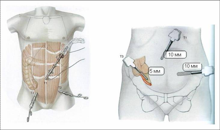 Removal of appendicitis using laparoscopy