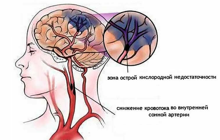 От гипоксии страдает мозг