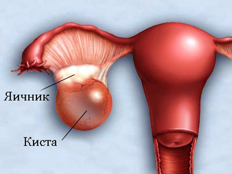 If a woman has a cyst on the right ovary, she has pain from this side.