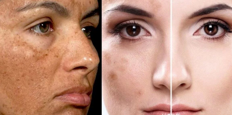 Macchie pigmentate correlate all'età sul viso