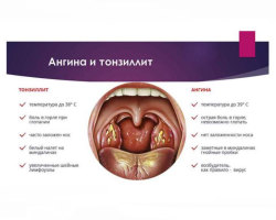 Tonsillitis, sore throat - the same thing or not: how to distinguish when antibiotics are prescribed?