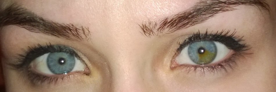 Woman's view with partial heterochromia