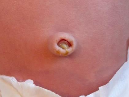 Pus in the navel of the baby is a sign of infection.