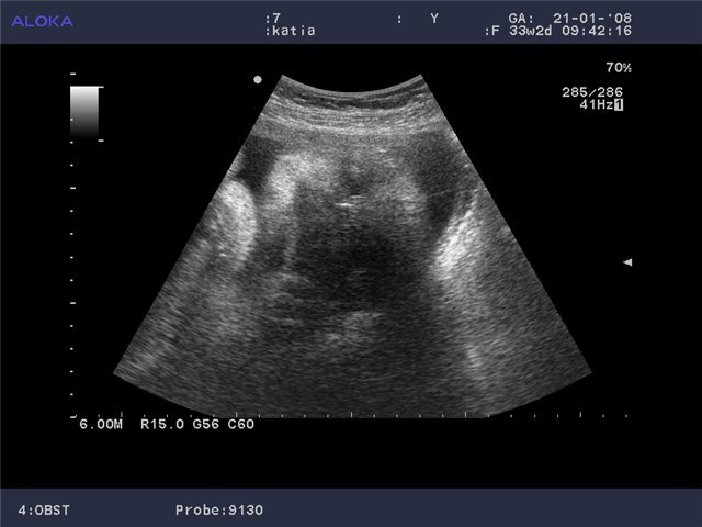 Indignation of umbilical cord in the photo ultrasound