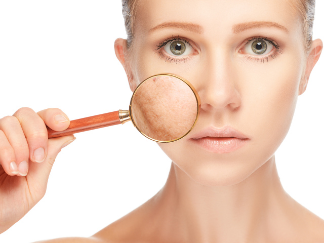 Επίλυση του δέρματος - τριχοειδή αγγεία στο πρόσωπο. Θεραπεία της ροδόχρων