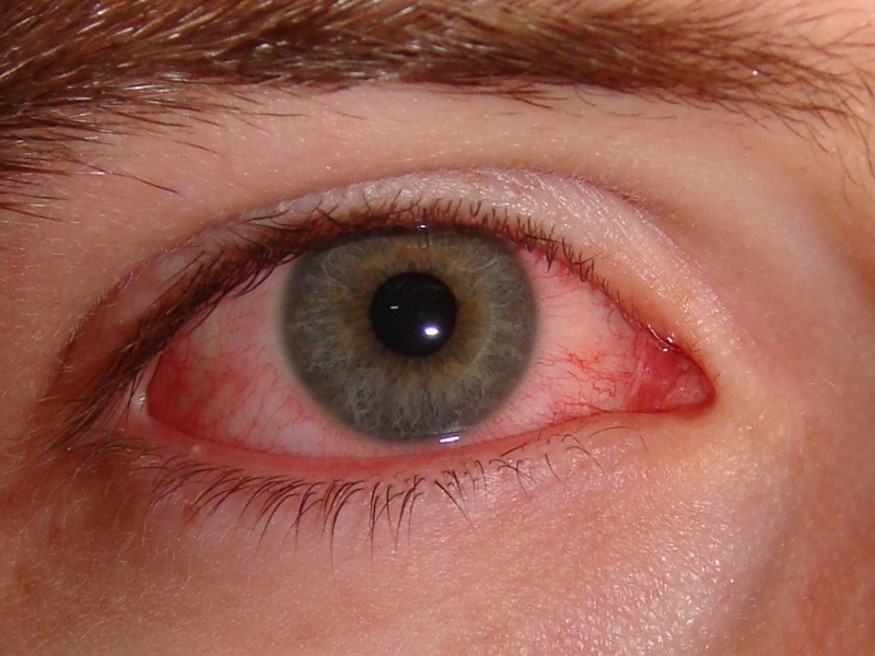 Установить точную причину красноты глаз может только врач