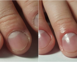 The cuticle grows quickly after a manicure, what to do? The reasons for the rapid growth of the cuticle after hardware manicure