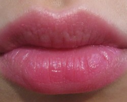 La lèvre est très gonflée - la partie supérieure, inférieure: causes, traitement