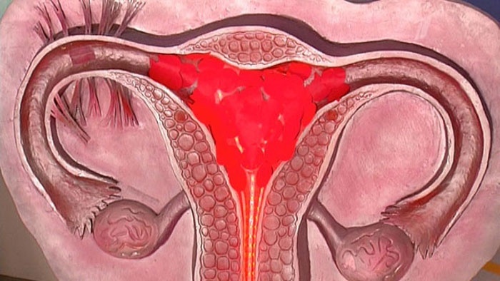 Pourquoi y a-t-il des menstruations abondantes avec des caillots?