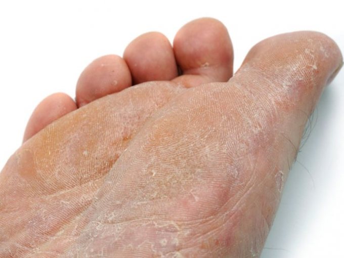 Causes of peeling, itching on the legs
