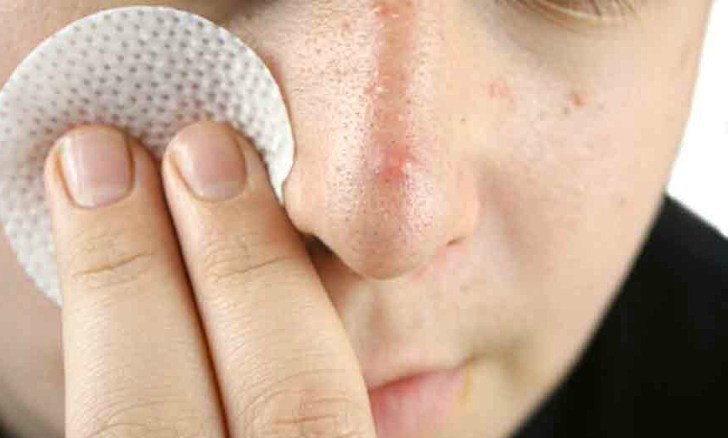 L'acné sur le nez chez les hommes peut apparaître en raison d'une consommation de stéroïdes.