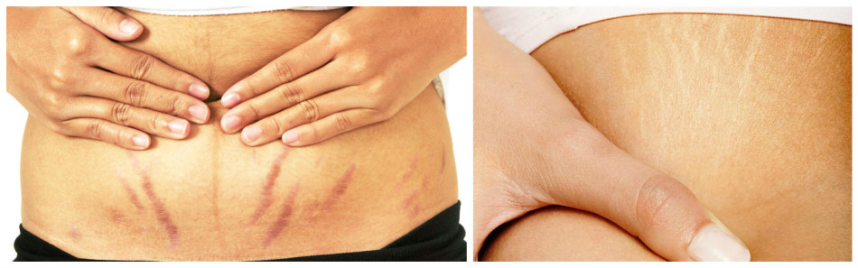 In the photo: on the left - the initial stage of the maturity of stretch marks, on the right - old stretching/striae