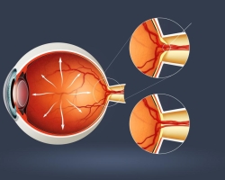 Mata Glaukoma: Apa itu, penyebab, gejala, konsekuensi, pencegahan