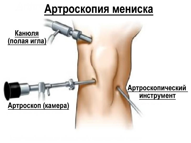 Артроскопия