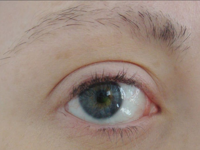 คิ้วและขนตาหลุดออกมาและผอม - นี่เป็นสัญญาณของโรคอะไร: เหตุผลที่ต้องทำวิธีการรักษาวิธีกำจัดยาอะไรที่ต่อต้านการสูญเสียยา?