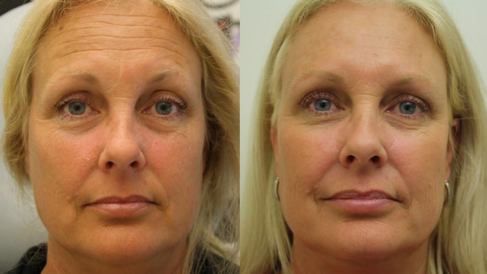 Botox pred in po
