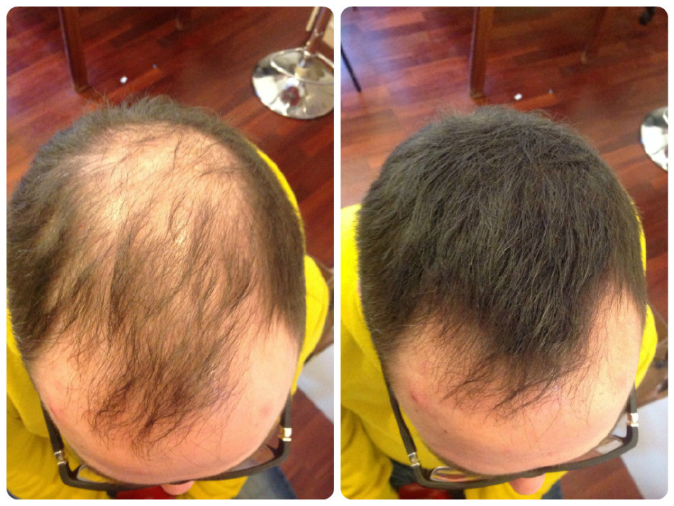 Поможет ли мужчине мезотерапия вернуть волосы на голове