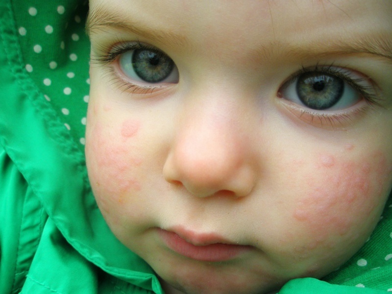 Allergies in children