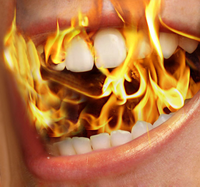 Para dokter menyebut pembakaran glossal terbakar di mulut.