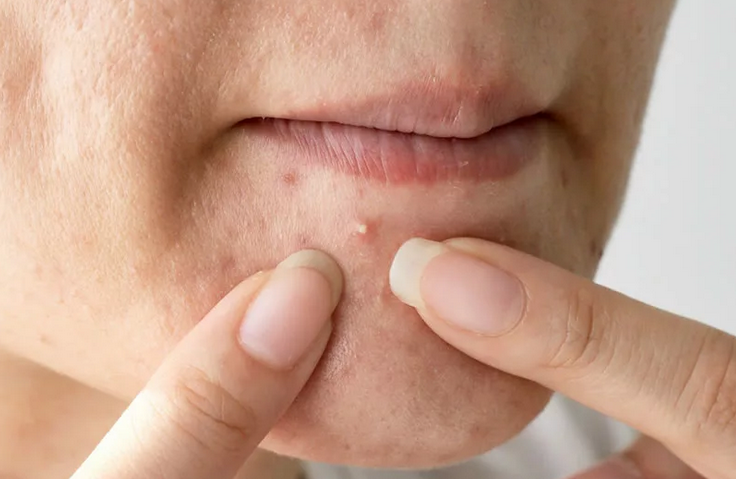 Un soin inapproprié pour la peau grasse peut provoquer l'acné sur le menton