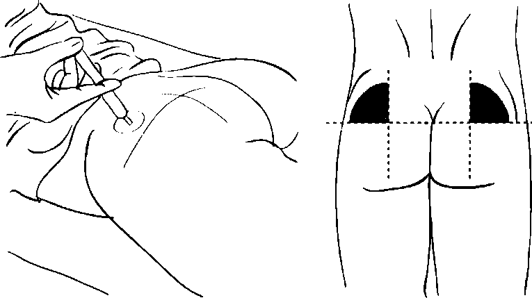 Схема постановки внутримышечного укола.