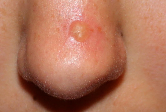 Purulent pimple on the nose.