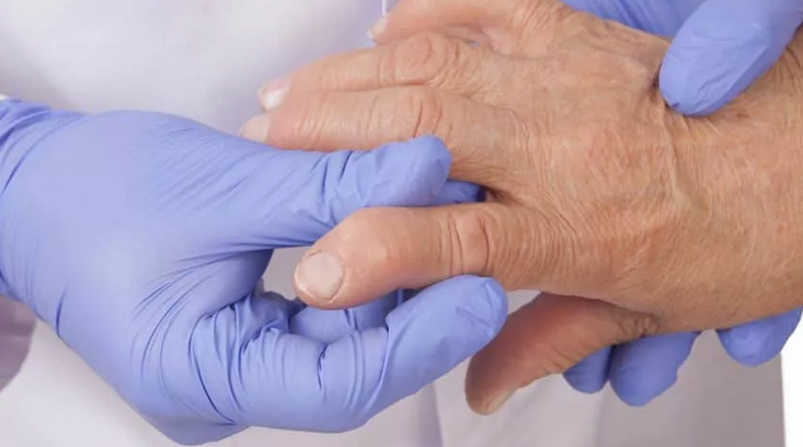 Rheumatoid arthritis: autoimmune disease, cause of temperature