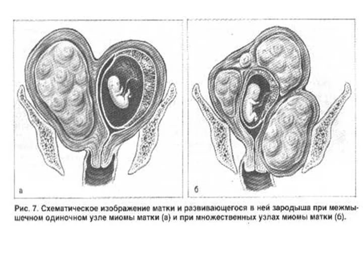 Uterine fibroids during pregnancy