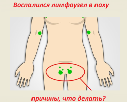 Nodul limfatic în inghinala unei femei, bărbați: motive, ce să facă? Cum se tratează limfadenita: medicamente, metode populare