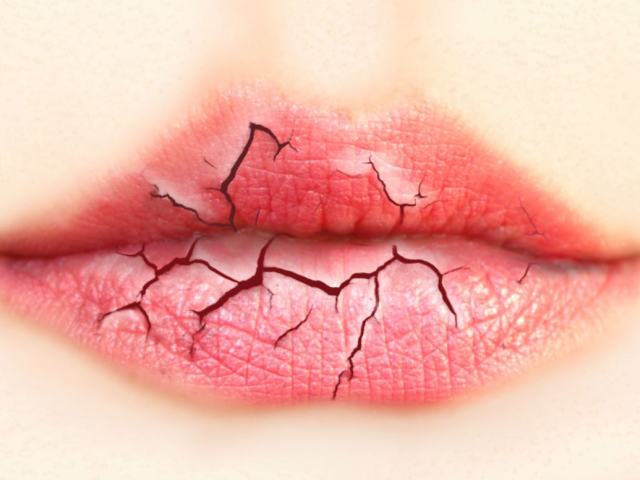 Lip diseases - Heit: symptoms and causes. Heilite treatment in children and adults. Ointments and folk remedies from Heilite