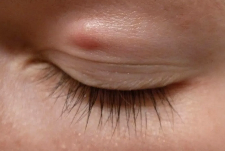 Lipoma - udarce na obrazu