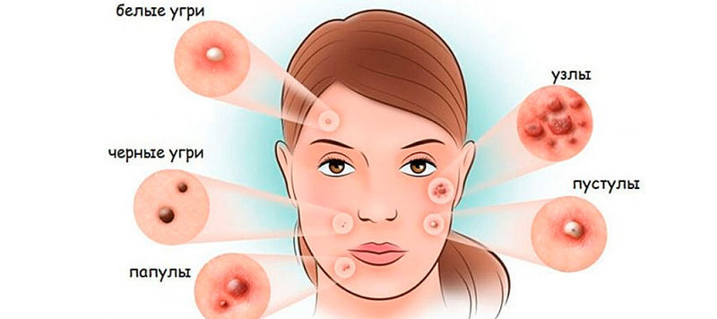 Various types of acne