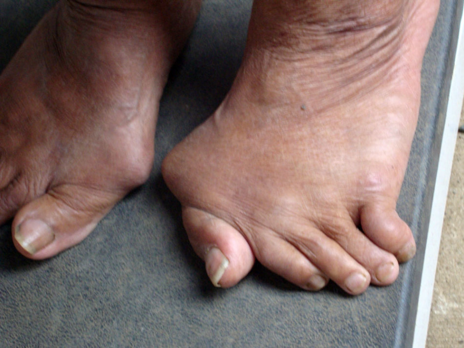 Development of the foot