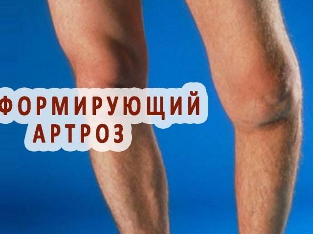 Деформирующий артроз коленного сустава: симптомы, причины, методы медикаментозного лечения. Что такое деформирующий артроз коленного сустава?