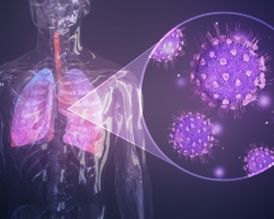 Pljučna in pljučnica: ista stvar ali ne, kakšna je razlika, znaki. Kakšna je razlika med pljučnico in koronavirusno pljučnico?