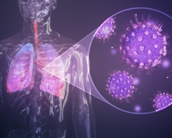 Pneumonie et pneumonie: la même chose ou non, quelle est la différence, les signes. Quelle est la différence entre la pneumonie et la pneumonie du coronavirus?