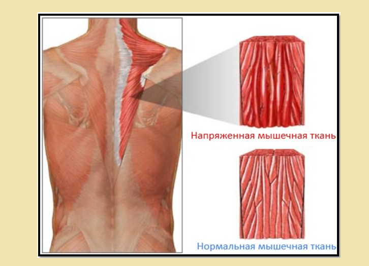 Продуло спину: мышечная ткань напряжена